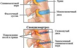 Спондилоартроз поясничного отдела позвоночника что это такое