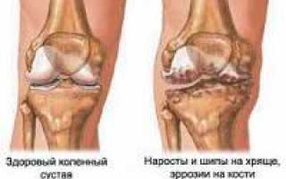 Диагностика артроза коленного сустава
