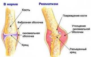 Как вылечить ревматизм