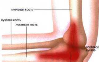 Болит сустав локтя