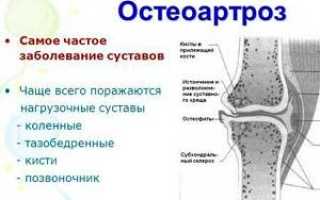 Остеоартроз тазобедренного сустава лечение