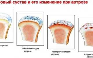 Препараты для лечения артроза тазобедренного сустава