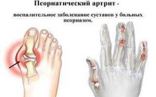 Псориаз артрит