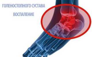 Посттравматический артрит голеностопного сустава