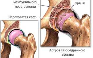 Признаки артроза тазобедренного сустава