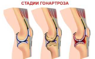 Упражнения при гонартрозе коленного сустава