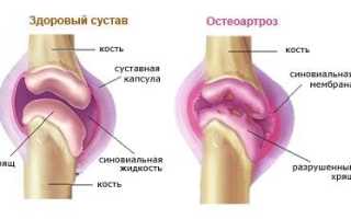 Какие хондропротекторы лучше при артрозе