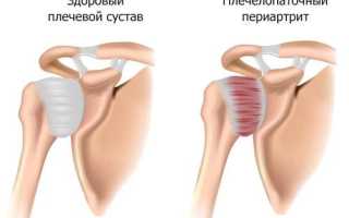 Плечевой полиартрит симптомы и лечение