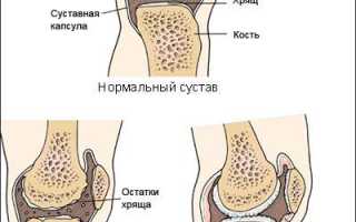 Ревматический артрит