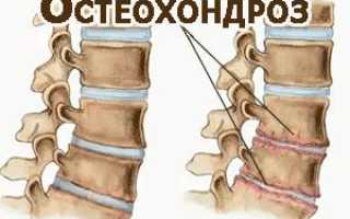 Вылечить остеохондроз