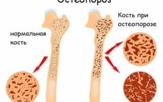 Остеопороз 1 степени