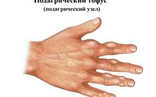 Подагрические тофусы