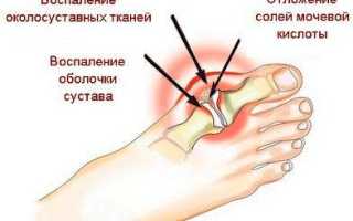 Симптомы и лечение подагры на ногах