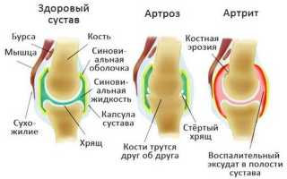 Артрит или артроз