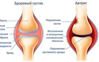 Средство от артрита