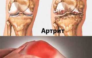 Лечение при артрите коленного сустава