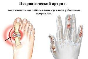 псориатический артрит