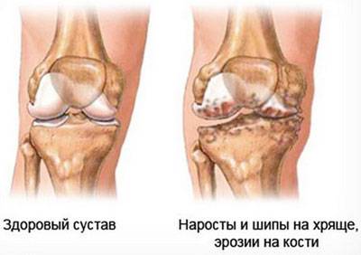Проявление гонартроза коленного сустава