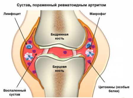 артрит колена
