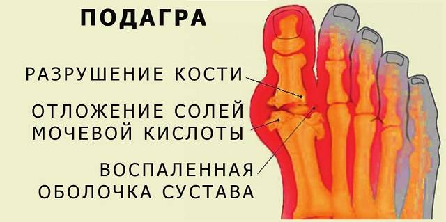 podagra32