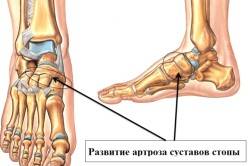 Схема артроза суставов стопы