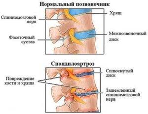 Спондилоартроз