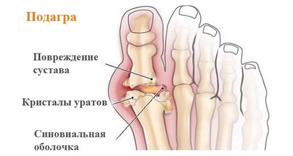 Что такое подагра
