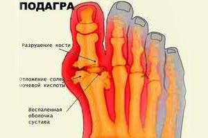 Подагра