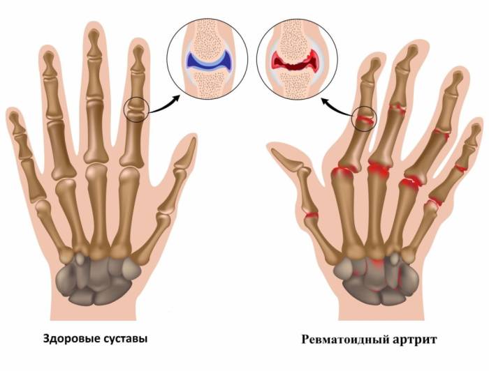 Профилактика ревматоидного артрита
