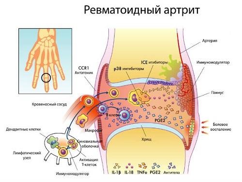 Профилактика ревматоидного артрита