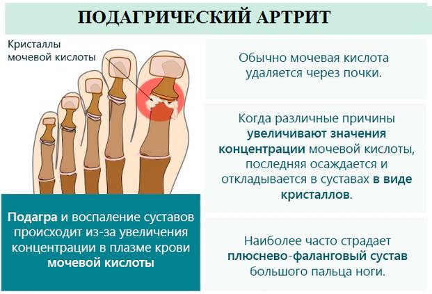 Что такое подагрический артрит