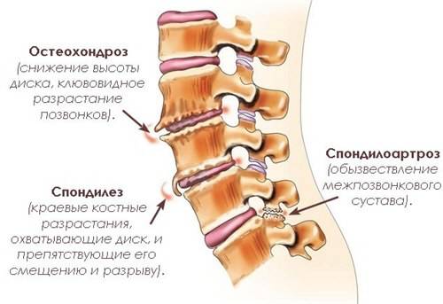 Особенности артроза позвоночника
