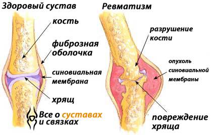 Ревматизм суставов