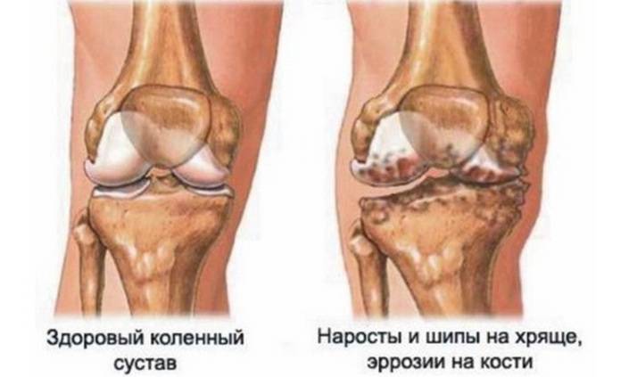 Гонартроз колена