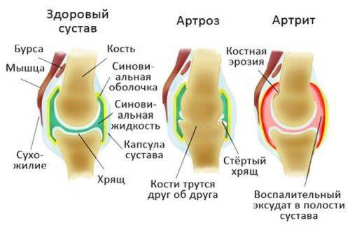 Кто лечит артрит какой врач