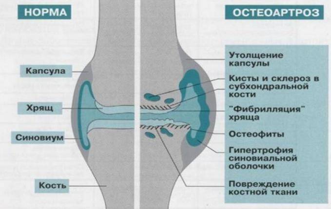 Остеоартроз коленного сустава