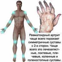 Ревматоидный артрит последствия
