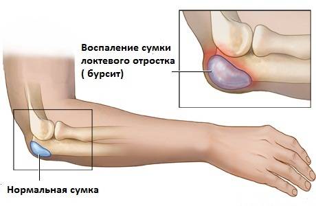 Локтевой сустав при бурсите наглядно
