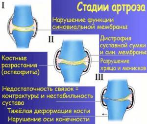 стадии артоза
