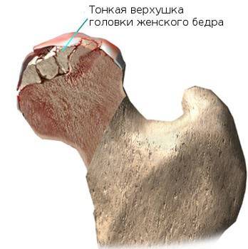 Болезнь Пертеса