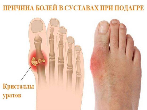 Подагра