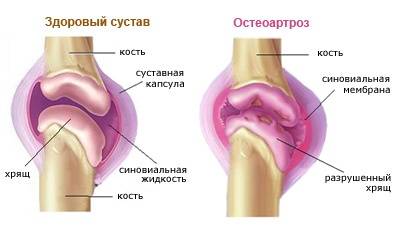 Хондропротекторы при артрозе