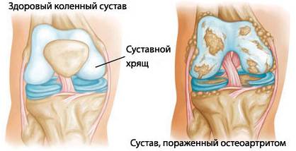Сустав, параженный остеоартритом