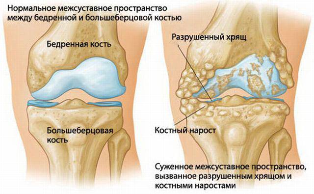 Развитие артрита