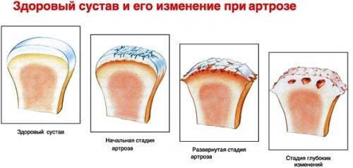 Разрушение сустава при артрозе