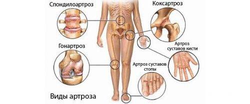 Виды артрозов по месту расположения