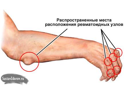 ревматоидные узлы
