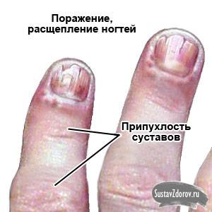 симптомы псориатического артрита