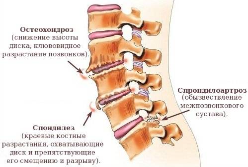 Полисегментарный спондилоартроз