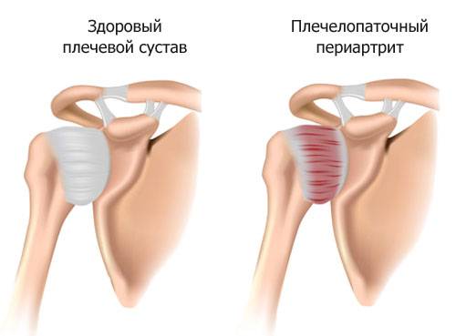 плечелопаточный периартрит